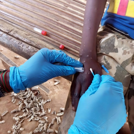 Patented Technology, Bioteke Monkeypox Detection Solutions - Helping ...